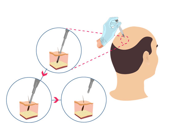 Wie wird die DHI-Haartransplantation durchgeführt?